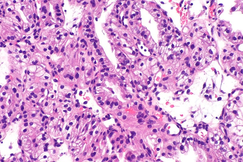 Informace o onemocnění tuberózní sklerózou