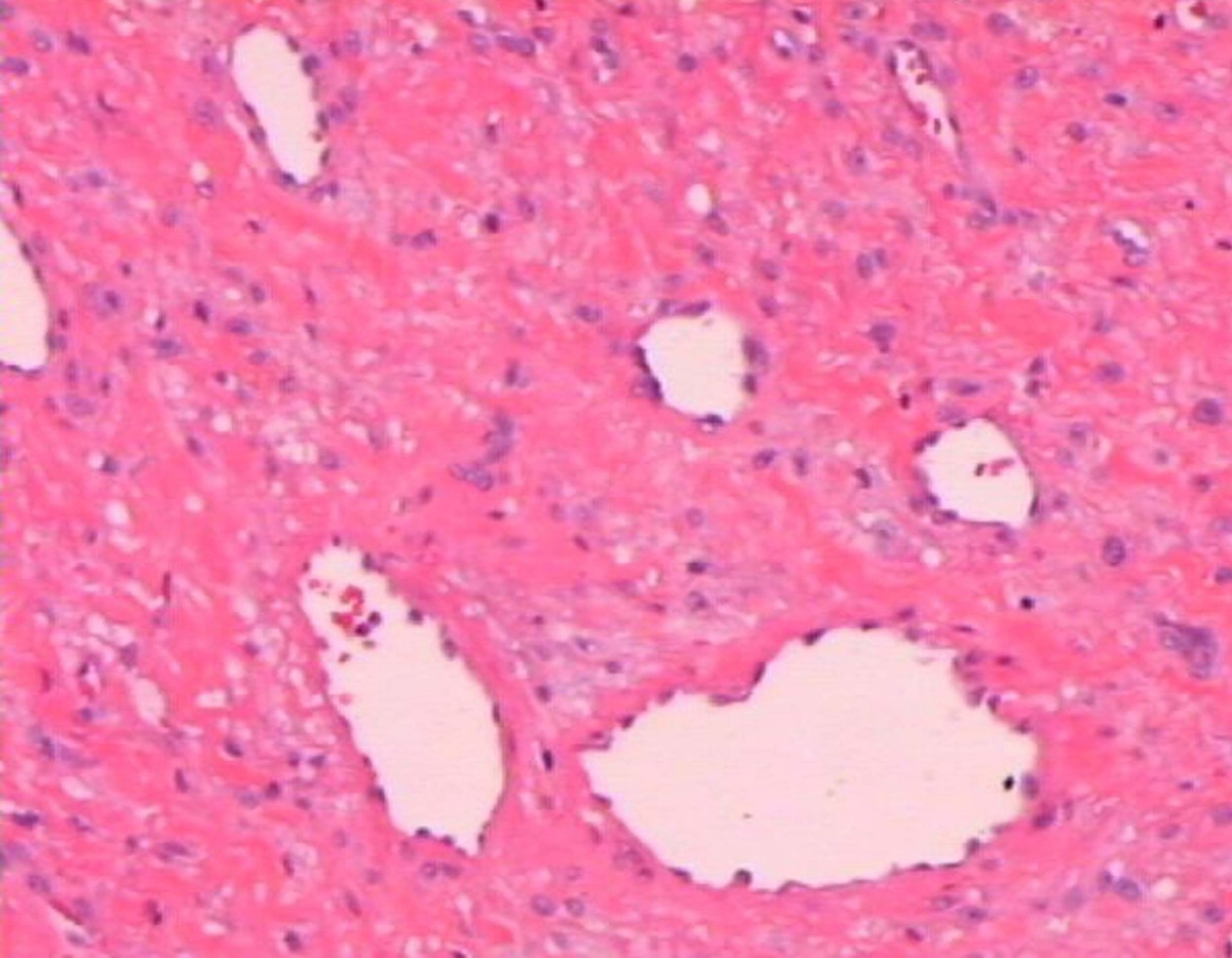 Diagnostika tuberózní sklerózy