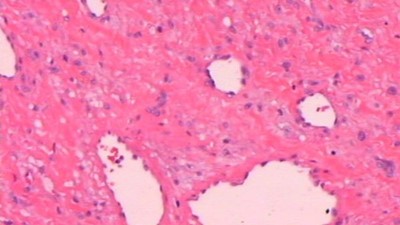 Diagnostika tuberózní sklerózy